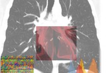 Ai-Score, l’intelligenza artificiale per calcolare il rischio Covid-19