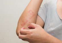 Psoriasi, un corto per superare vergogna, depressione e isolamento