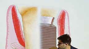 Implantologia conservativa. Il metodo del dr. Giorgio Stroppa (Mantua Dental) parodontologo certificato a livello europeo