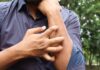 Studio Novartis, l’orticaria cronica spontanea costa 4.200 euro l’anno a paziente