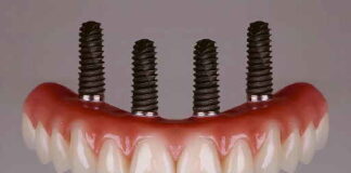 I CONSIGLI DEL DR. GIORGIO STROPPA Denti fissi in tempi rapidi? Il carico immediato può essere una soluzione per molti pazienti
