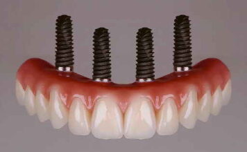I CONSIGLI DEL DR. GIORGIO STROPPA Denti fissi in tempi rapidi? Il carico immediato può essere una soluzione per molti pazienti