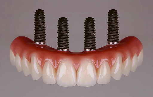 dentifissi2